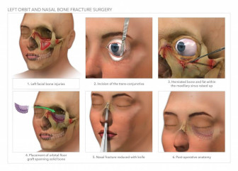 Left Orbit and Nasal Bone Fracture Surgery