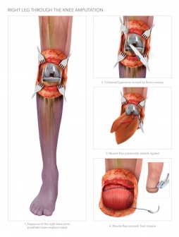 Right Leg Through the Knee Amputation
