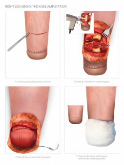 Right Leg Above the Knee Amputation