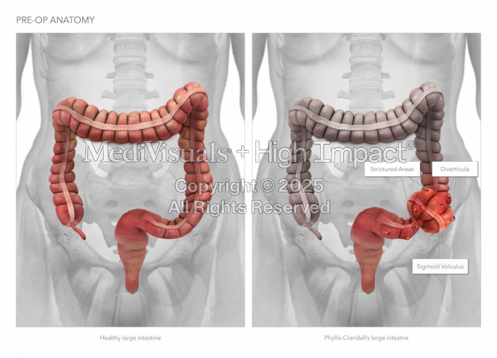 Pre-Op Anatomy