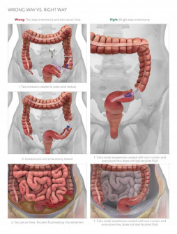 Wrong Way Vs. Right Way Enterotomy