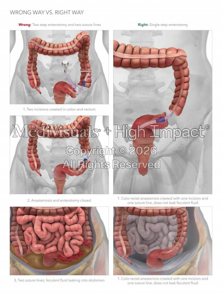 Wrong Way Vs. Right Way Enterotomy