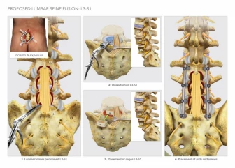 Proposed Lumbar Spine Fusion