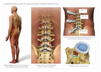 Lumbar Radiculopathy and Epidural Steroid Injections