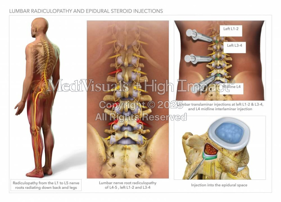 Lumbar Radiculopathy and Epidural Steroid Injections