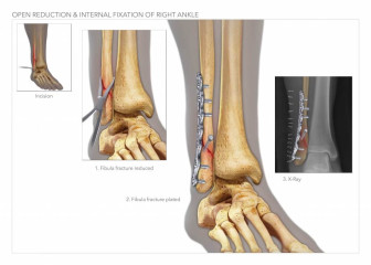 Open Reduction & Internal Fixation of Right Ankle