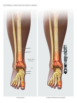 External Fixation of Right Ankle