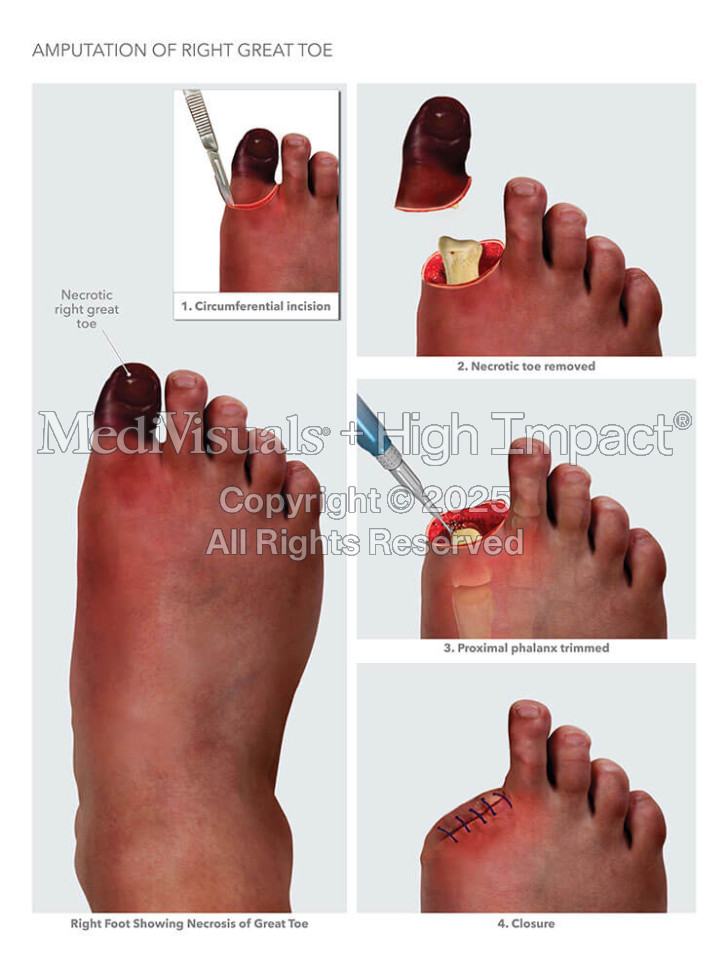 Amputation of Right Great Toe
