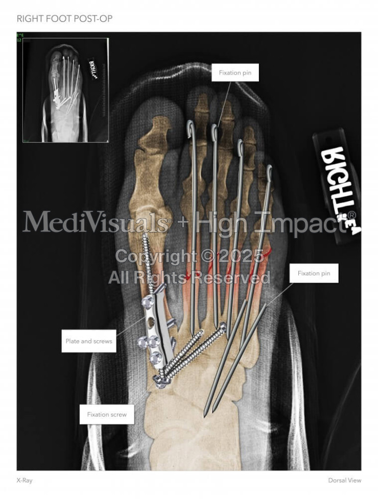 Right Foot Post-Op