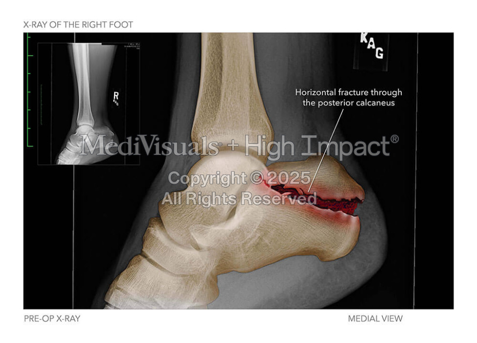 X-Ray of the Right Foot