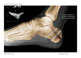 X-Ray of the Right Foot