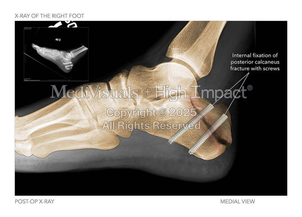 X-Ray of the Right Foot