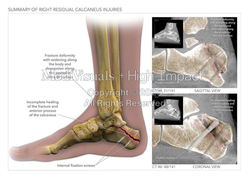 Summary of Right Residual Calcaneus Injuries