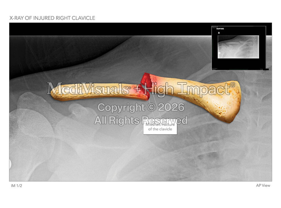 X-Ray of Injured Right Clavicle