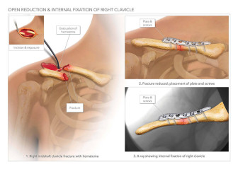 Open Reduction & Internal Fixation of Right Clavicle