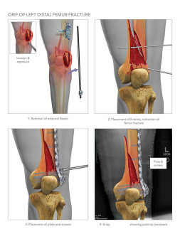 ORIF of Left Distal Femur Fracture