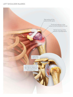 Left Shoulder Injuries