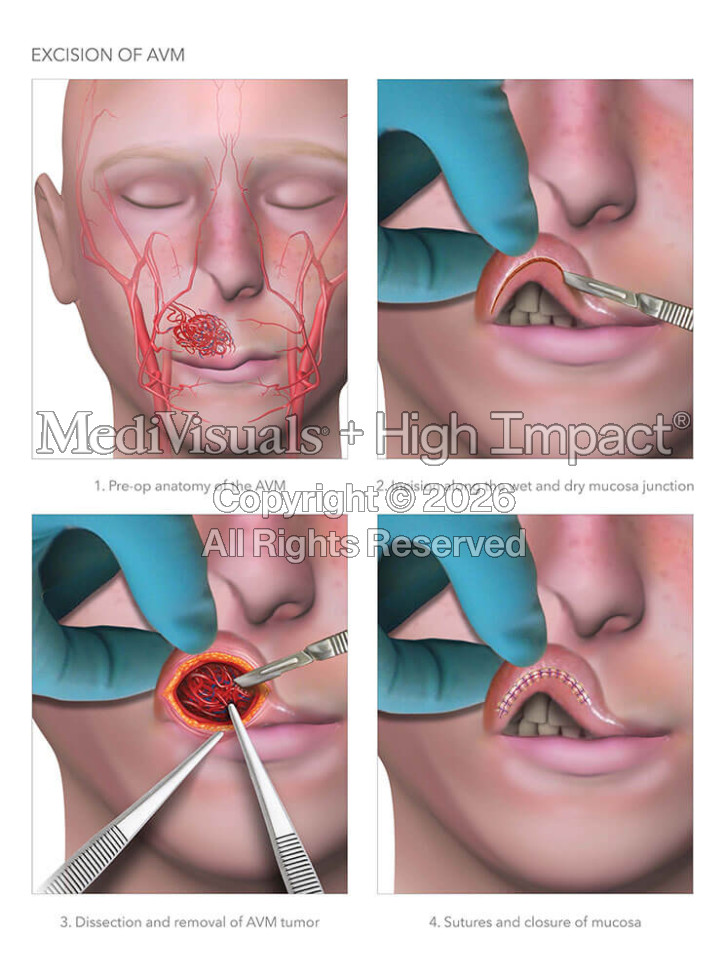 Excision of AVM