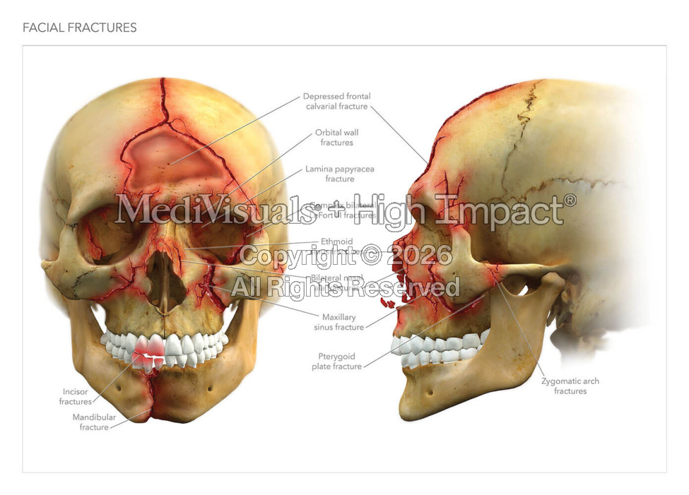 Severe Facial & Skull Fractures