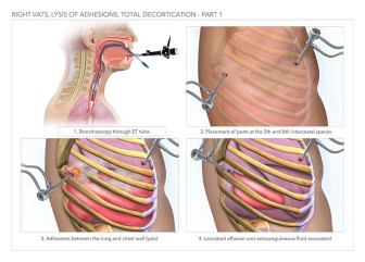 Right Vats, Lysis of Adhesions, Total Decortication