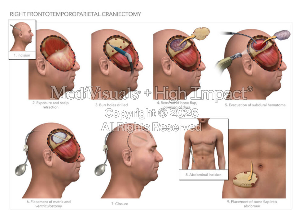 Frontotemporoparietal Craniectomy
