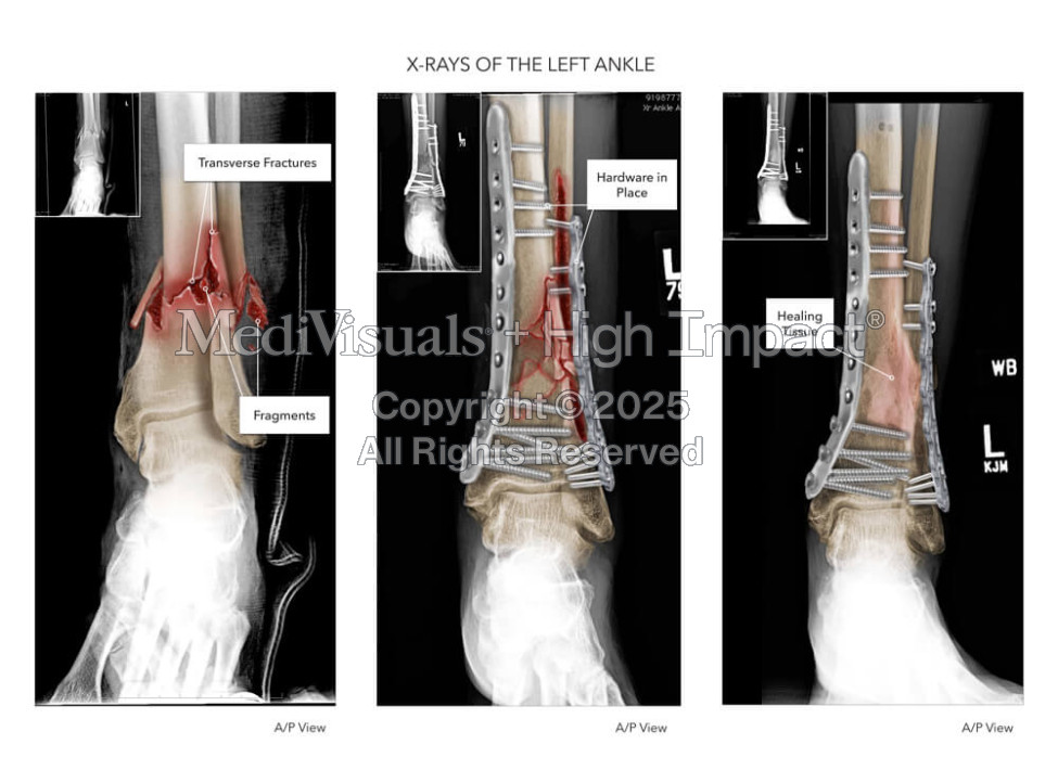 X-Rays of the Left Ankle