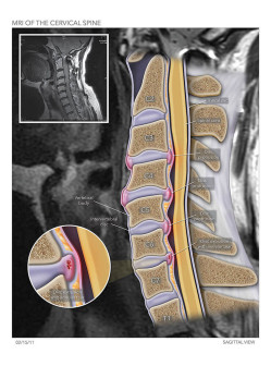 MRI of the Cervical Spine