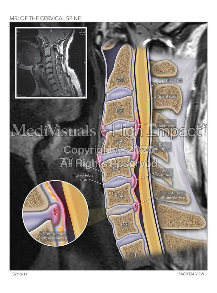 MRI of the Cervical Spine
