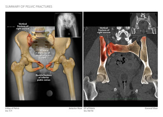 Summary of Pelvic Fractures