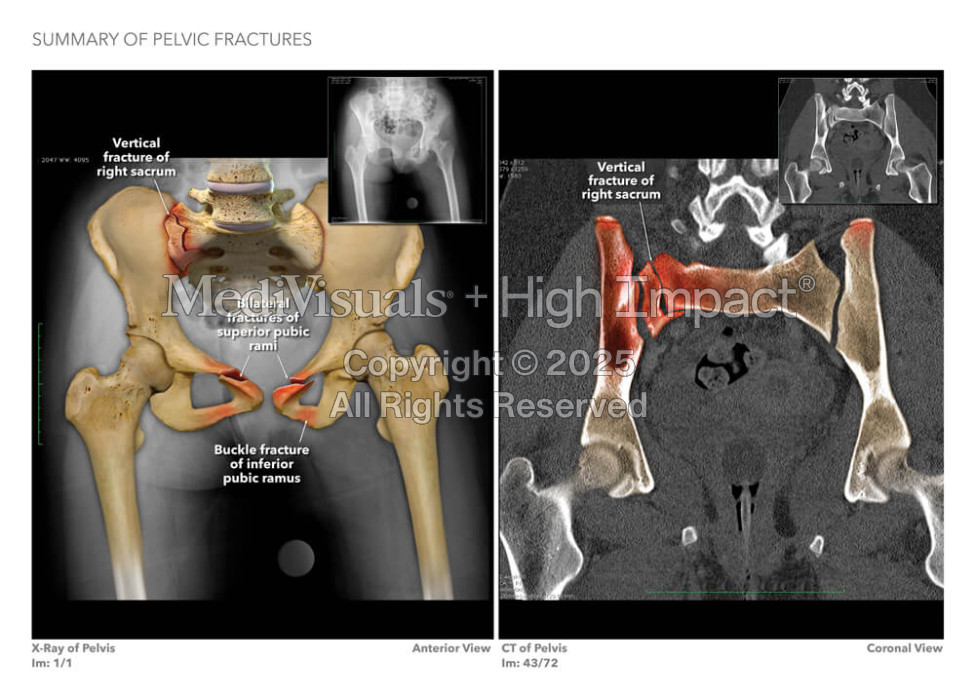 Summary of Pelvic Fractures