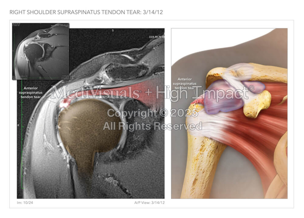 Anterior Supraspinatus Tendon Tear