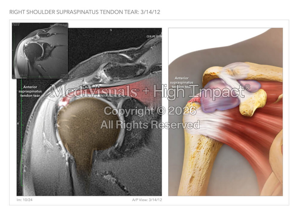 Anterior Supraspinatus Tendon Tear