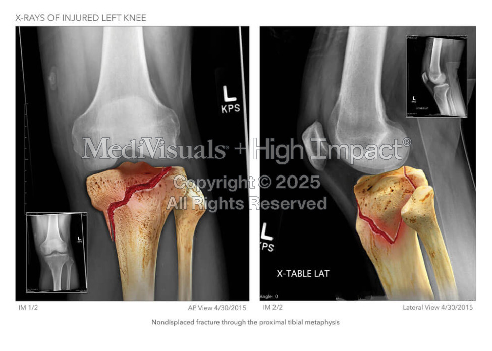 X-Rays of Injured Left Knee