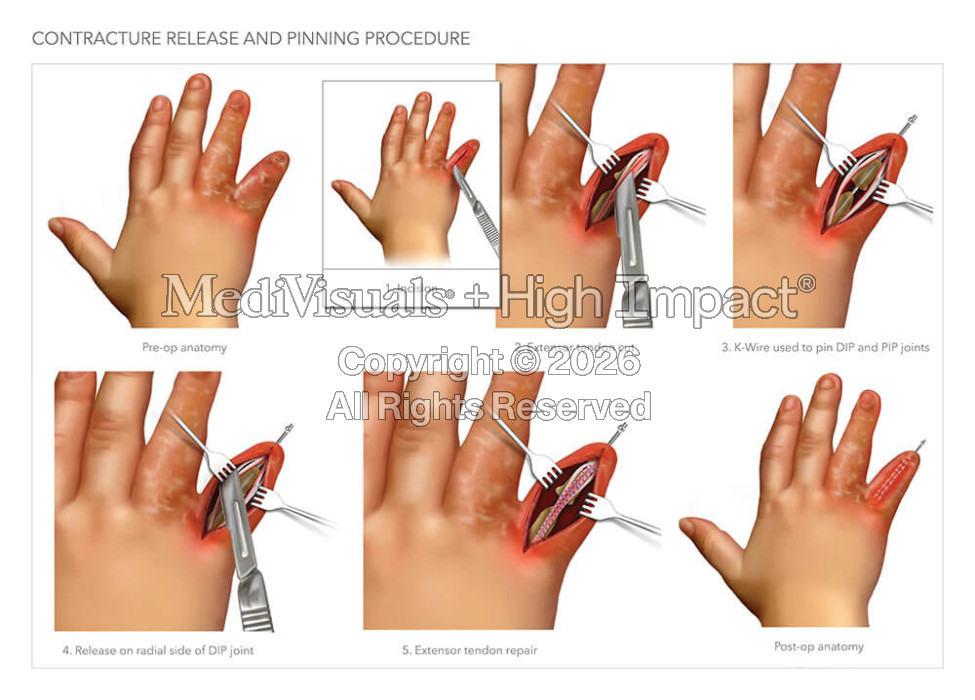 Amputation of Finger at PIP Joint