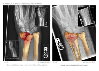 X-Rays of Wrist Injury and Repair