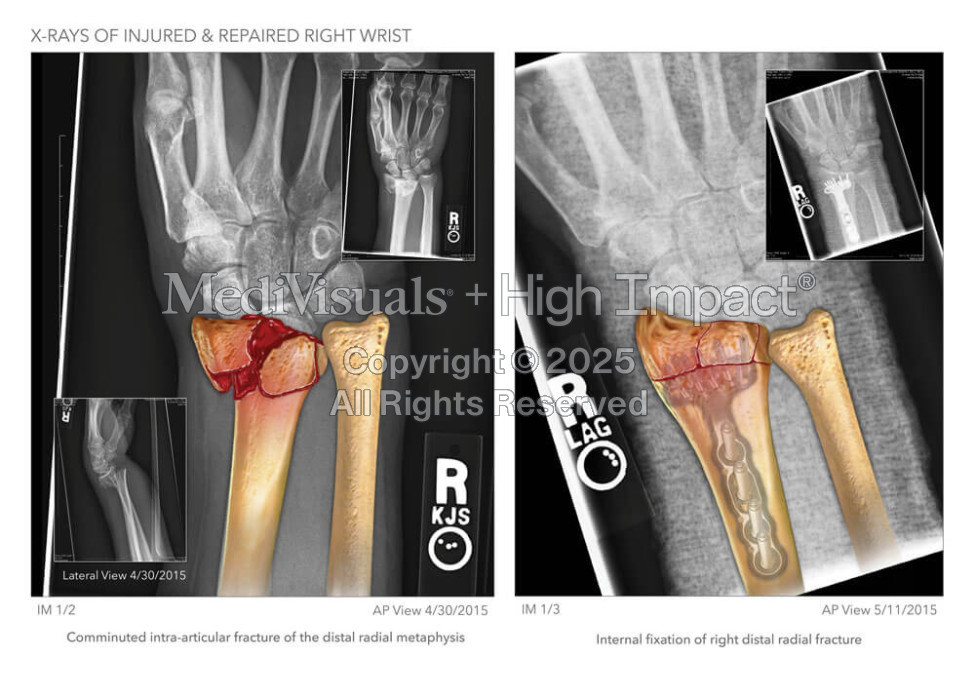 X-Rays of Wrist Injury and Repair