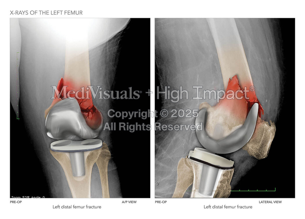 X-Rays of the Left Femur