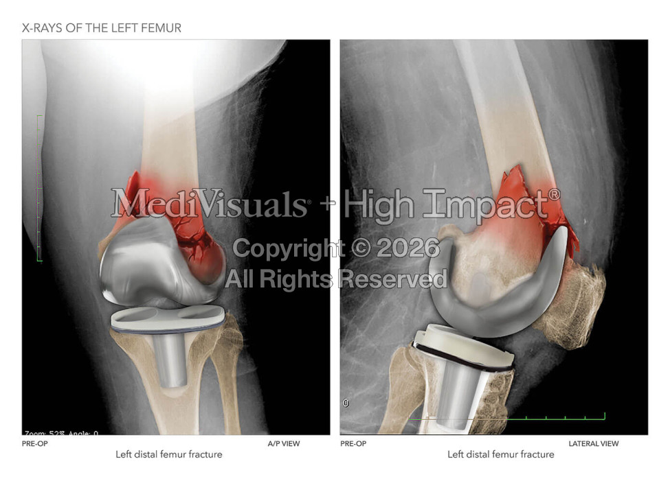X-Rays of the Left Femur