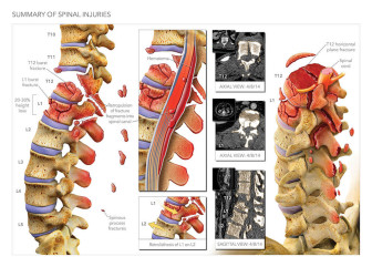Summary of Spinal Injuries