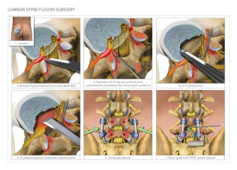 Lumbar Fusion Illustration