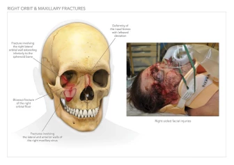 Orbital and Maxillary Fractures