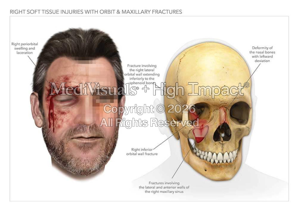 Orbit and Maxillary Fractures