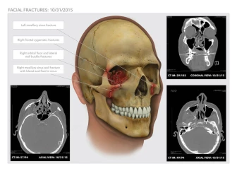 Facial Fracture on Eye Socket