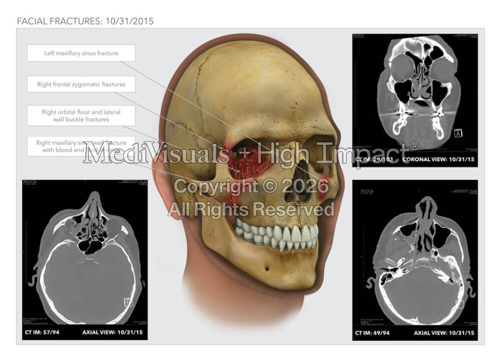 Facial Fracture on Eye Socket