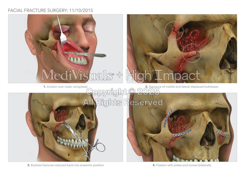 Facial Fracture Surgery