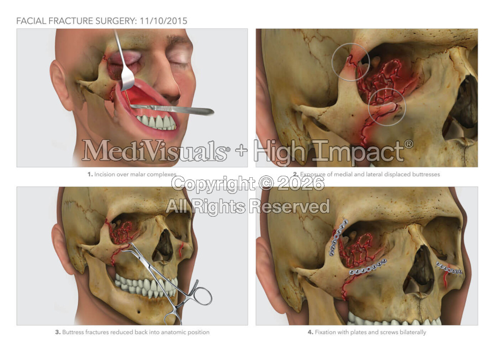 Facial Fracture Surgery