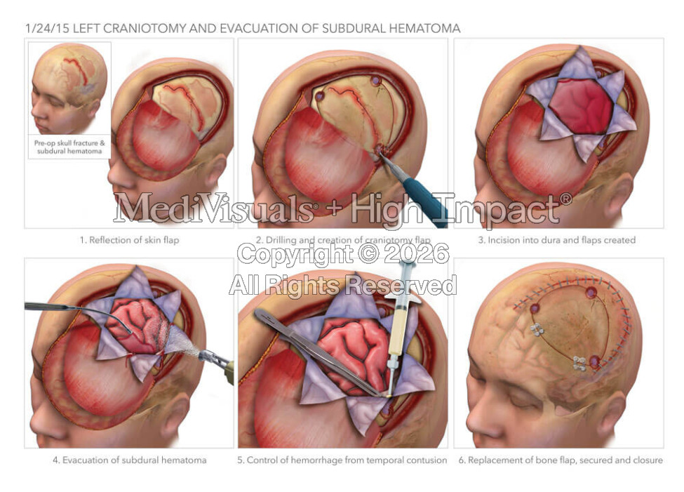 Craniotomy for Evacuation of Subdural Hematoma