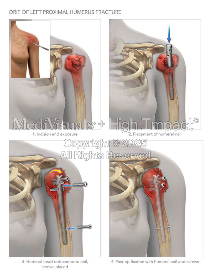 ORIF of Left Proximal Humerus Fracture