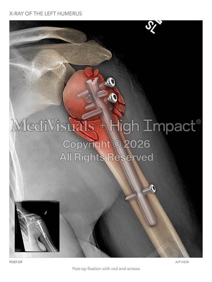 Post-Op X-Rays of the Humerus