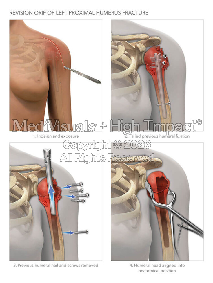 Revision ORIF of Humerus Fracture